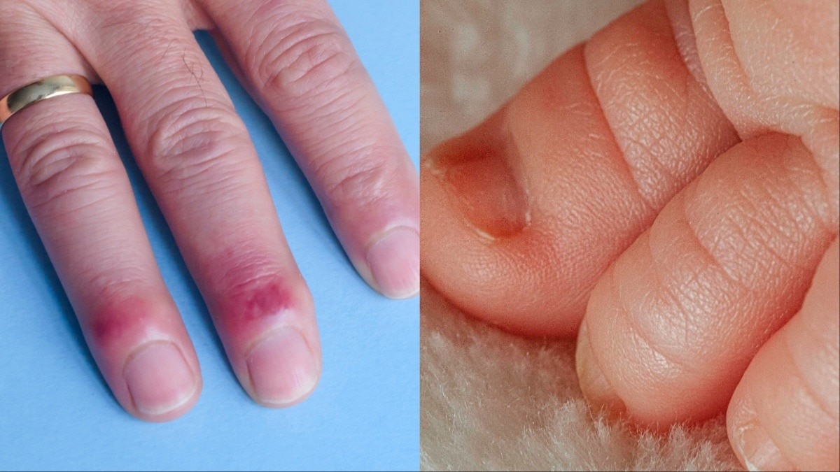 सर्दियों में हाथ-पैरों की उंगलियां की सूजन को दूर करने के लिए करें ये 4 उपाय (Photo- Getty Image)