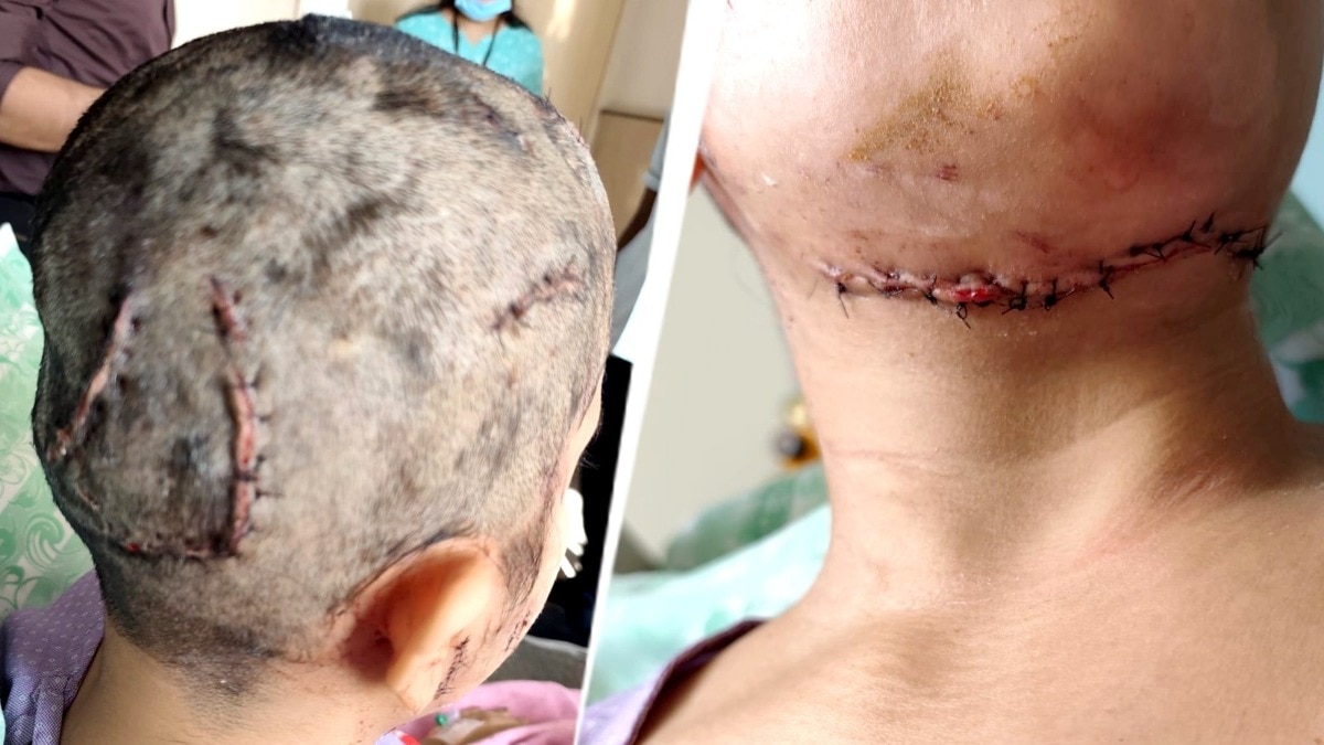 Pet Dog Attacks Woman During Morning Walk in Bengaluru