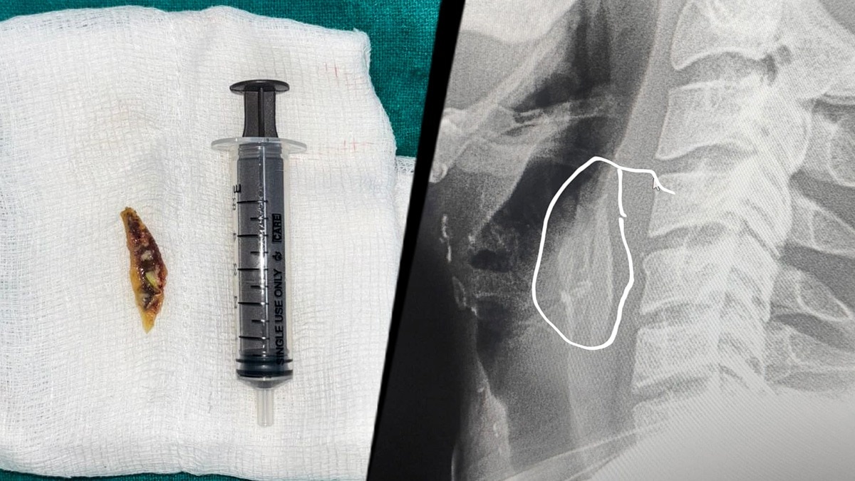 गले में चिकन की हड्डी फंसने से युवक की हालत हो गई खराब. (Photo: Manoj Purohit/ITG)