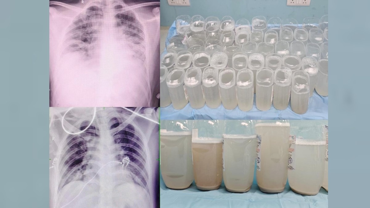 फेफड़ों की गहराई से सफाई की गई.(Photo:ITG)