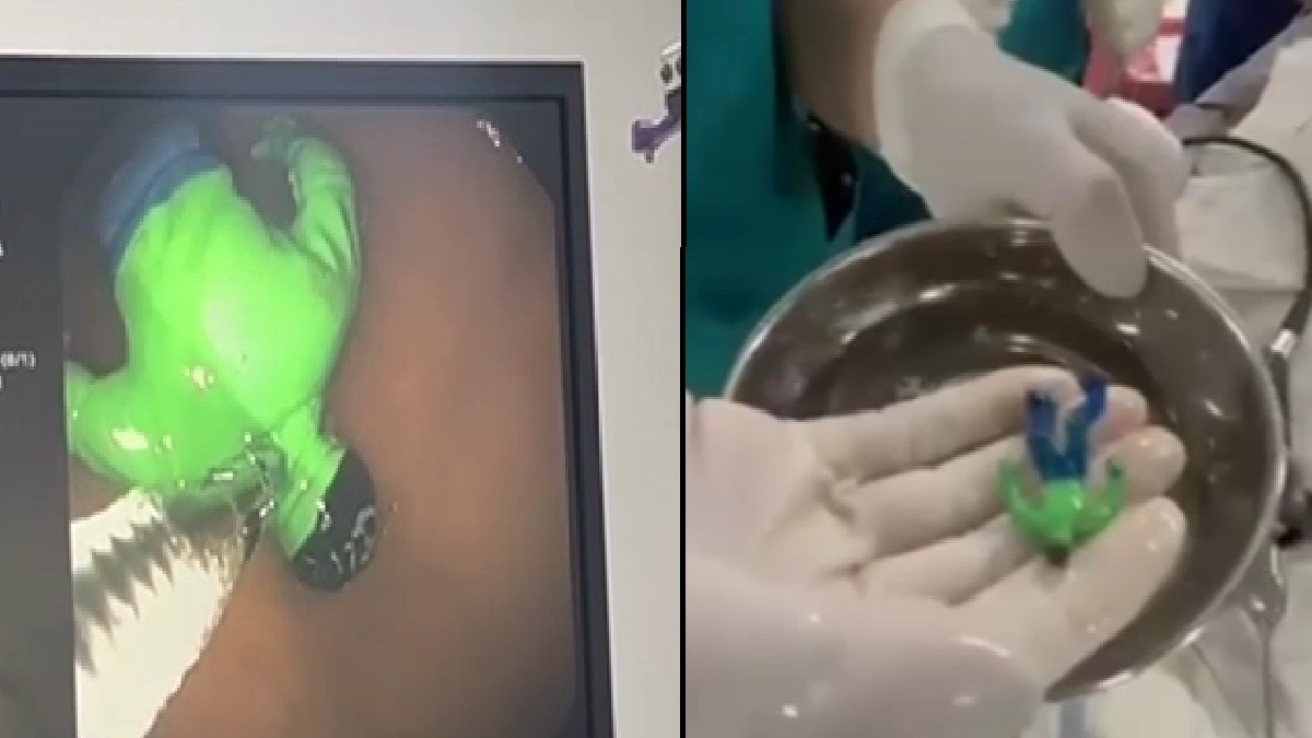 मासूम ने खेलते- खेलते निगल लिया प्लास्टिक का हल्क (Photo: itg)