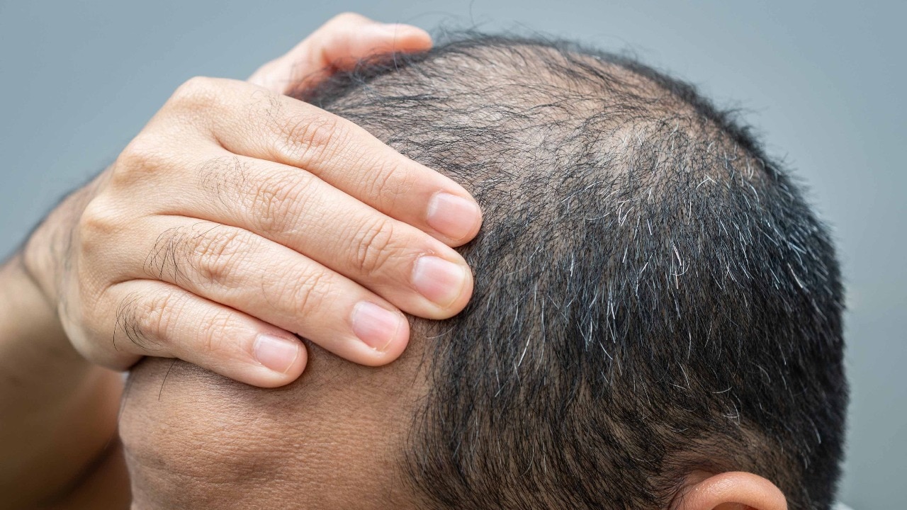 Baldness is usually most noticeable on the scalp, but it can happen anywhere on the body where hair grows.