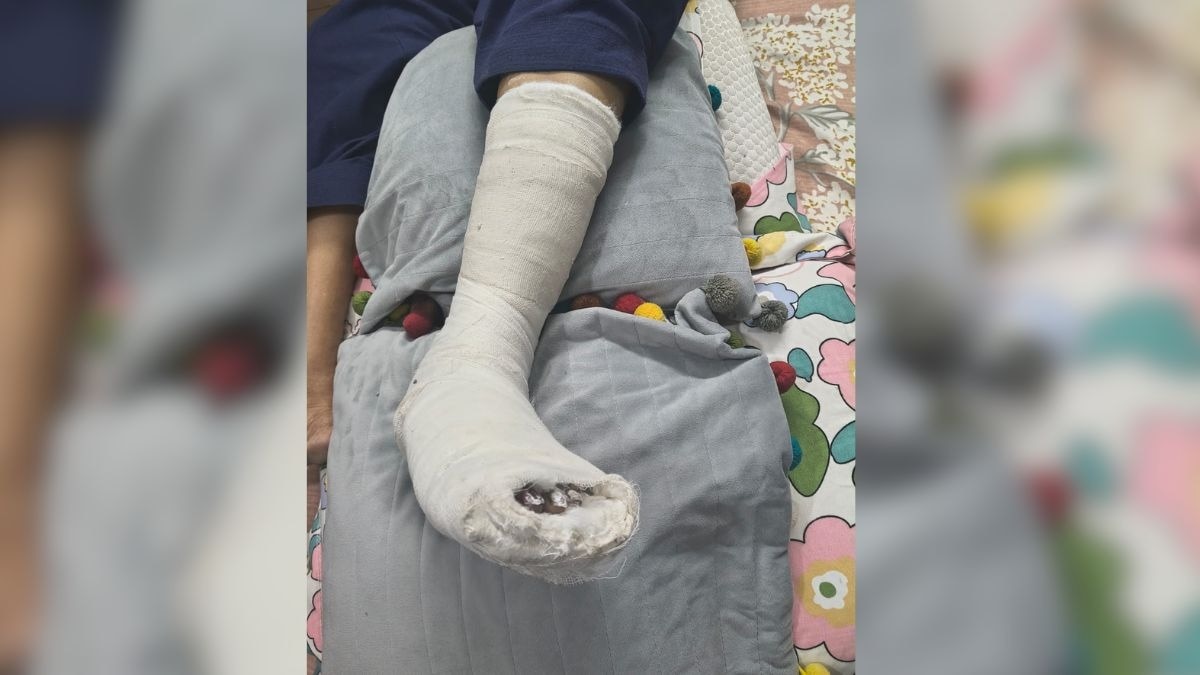 लिफ्ट में मौजूद महिला का पैर चार जगह से फैक्चर हो गया (Photo ITG)