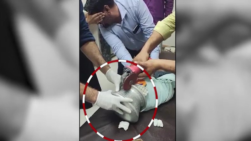 बर्तन को काटकर सिर से निकालती डॉक्टरों की टीम. (Photo: Screengrab) 