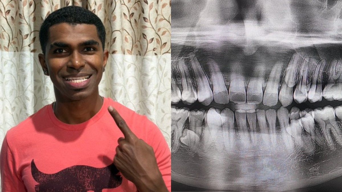man-with-42-teeth-sets-guinness-world-record-prathab-muniandy