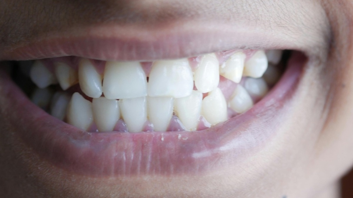 मलेशिया के Pratap Muniyandi ने मुंह में सबसे ज्यादा दांत होने का अनोखा रिकॉर्ड बनाया है. ( Photo: Pexels)