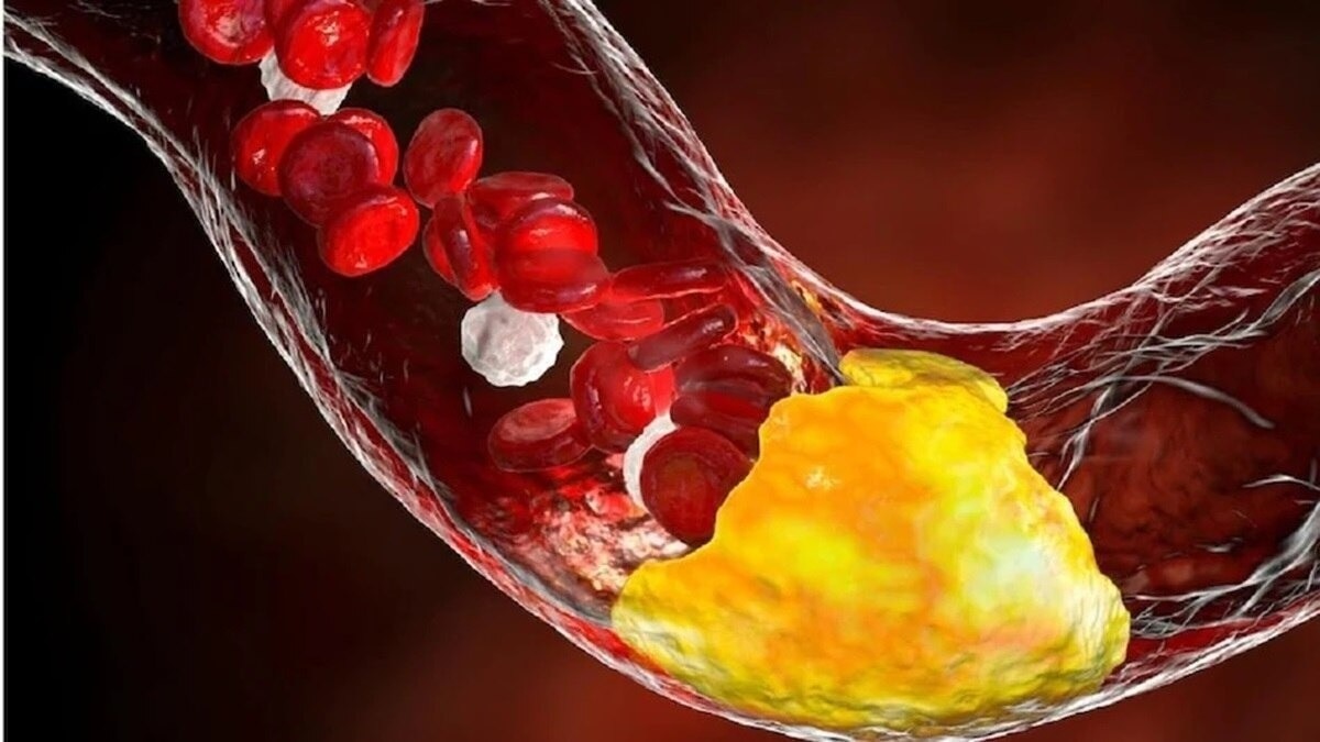 कोलेस्ट्रॉल नसों में जमने वाला चिपचिपा पदार्थ है. (Photo: ITG)