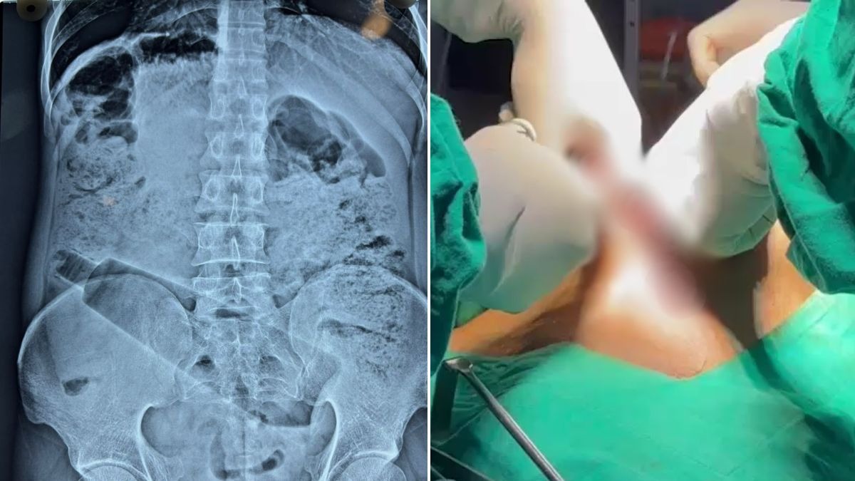 युवक ने नशे में शरीर के अंदर डाल ली थी बोतल. (Photo: Screengrab)