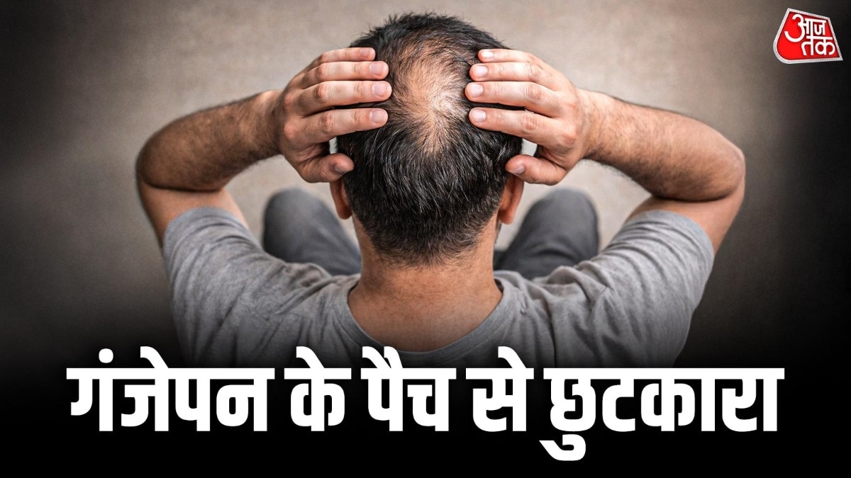 बाल उड़ने से जो पैच बनते हैं उसे एलोपेसिया एरीटा कहते हैं. (Photo: ITG)