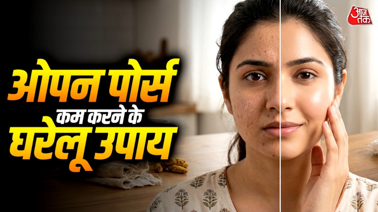 ओपन पोर्स की समस्या से हैं परेशान? अपनाएं ये घरेलू उपाय, दिखेगा असर