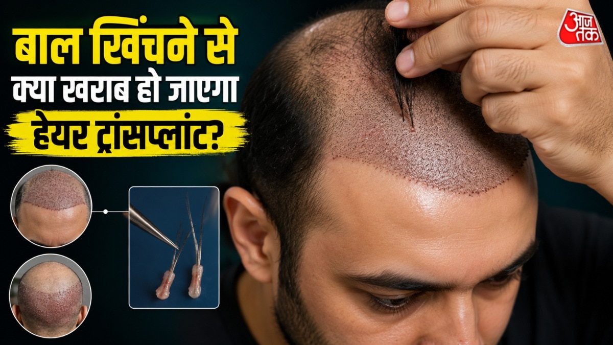 हेयर ट्रांसप्लांट में ग्राफ्ट लगाए जाते हैं. (Photo: ITG)