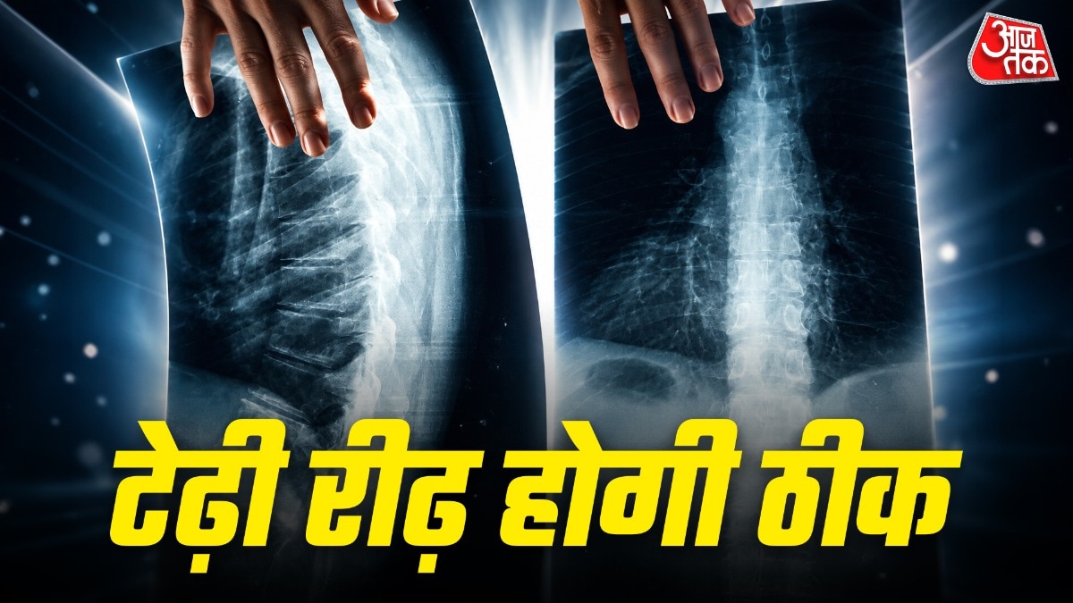  कंजेनिटल स्कोलियोसिस का इलाज