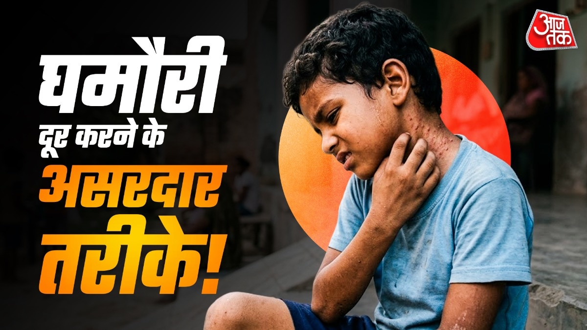गर्मी में घमौरी होना आम बात है (PHOTO:AI)