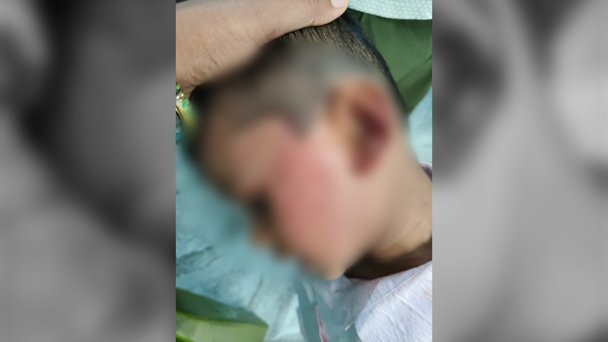 5-year-old nursery student was brutally beaten by the class monitor 