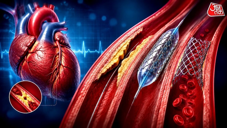 Yurak arteriyalarining tiqilishi paytida stent o'rnatish qachon talab etiladi: kardiolog tavsiyalari