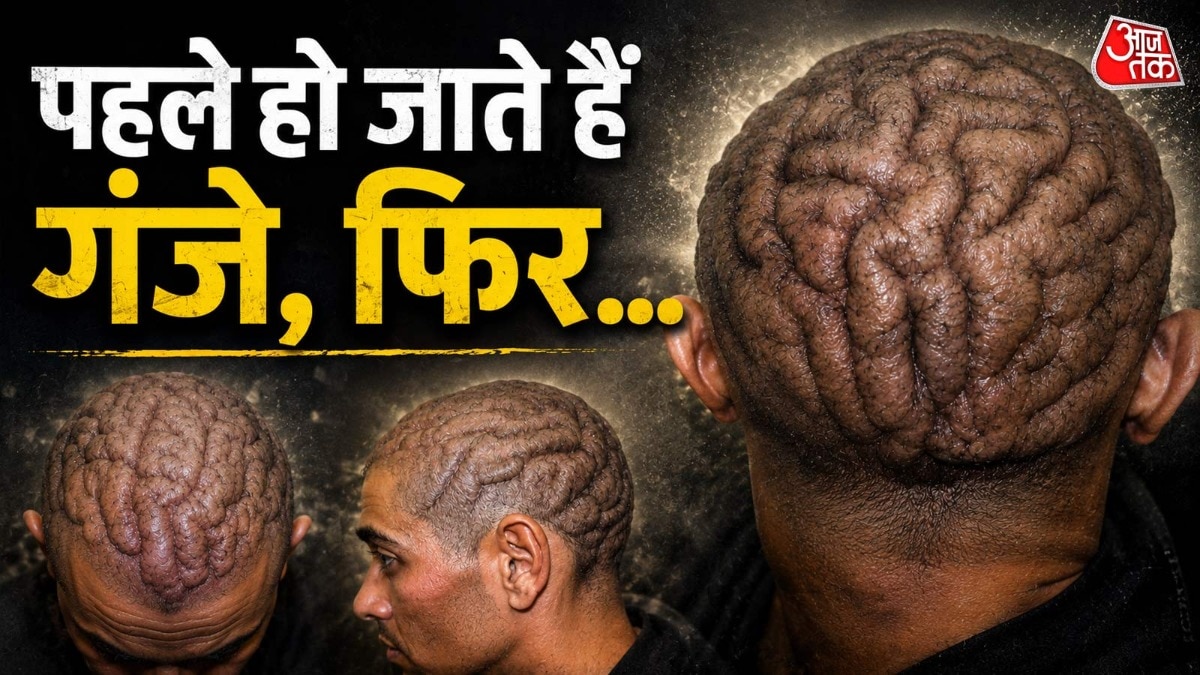 इस बीमारी से पत्थर जैसा हो गया युवक का सिर, लोग बोले- ऐसा पहले कभी नहीं देखा