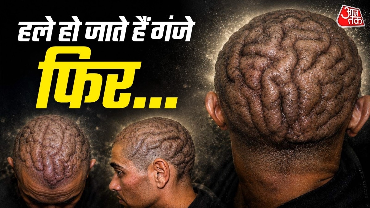 इस दुर्लभ बीमारी का नाम कटिस वर्टिसिस जाइराटा (Cutis Verticis Gyrata) है. ( Photo: ITG)
