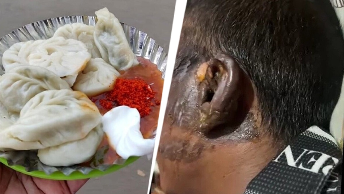 खोलते तेल से छात्र का चेहरा और कान झुलसा. (Photo: ITG)