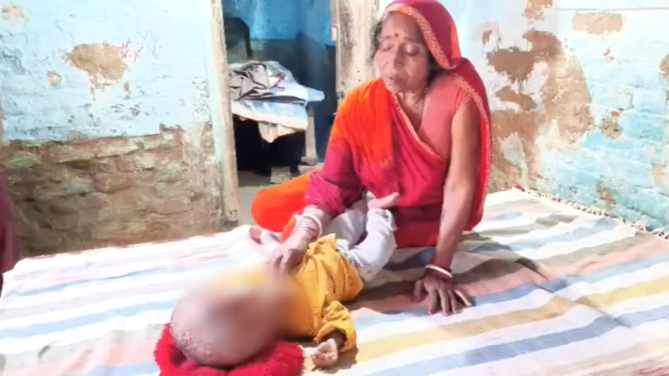 Pais de menino de Bihar pedem ajuda: peso da cabeça de criança de 18 meses atingiu 10 kg