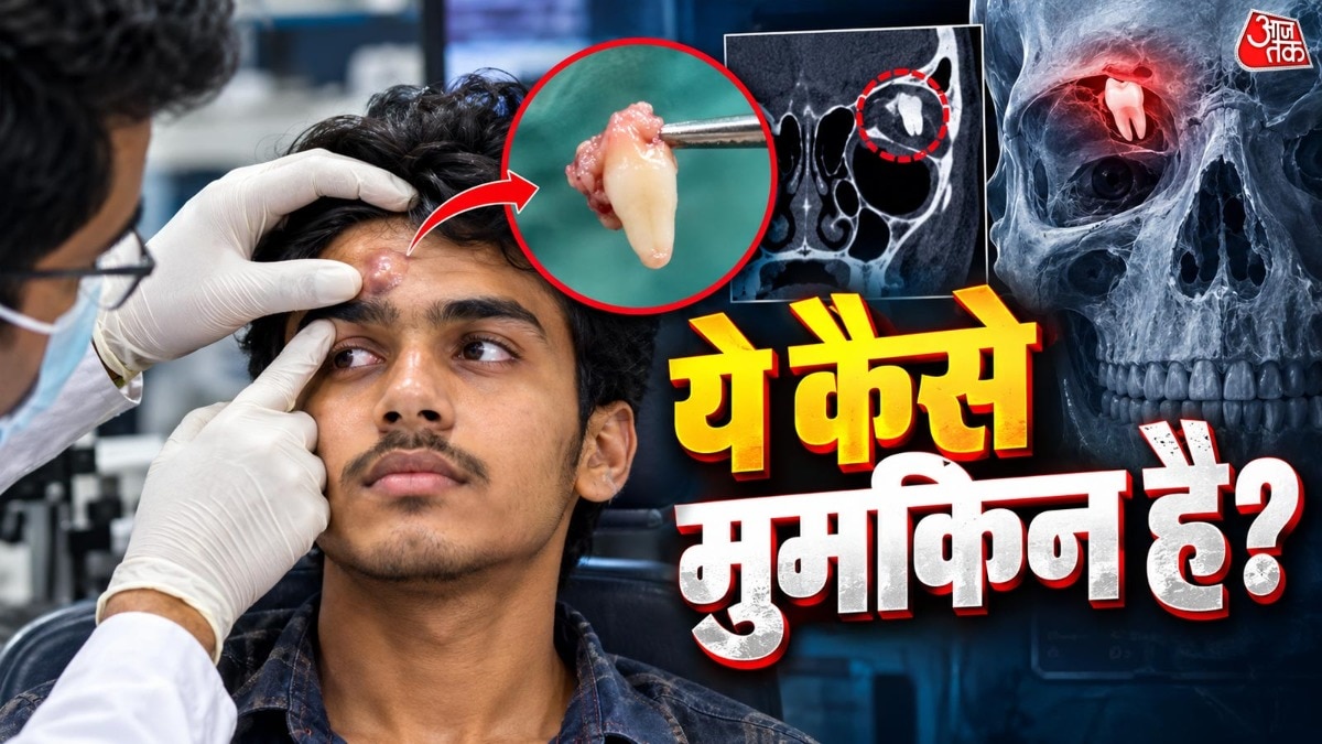 जानिए क्या है एक्टोपिक टूथ और शरीर में दांत गलत जगह कैसे विकसित हो सकता है. ( Photo: ITG)