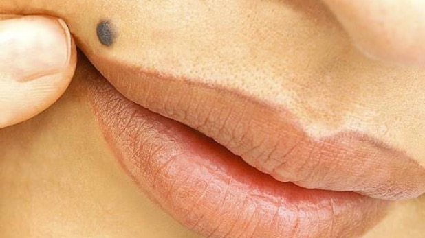 जानें, शरीर पर पाए जाने वाले तिल से जुड़ी खास बातें