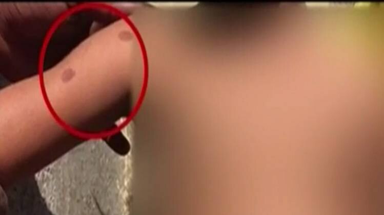 मुंबई मेट्रो: शरारत करने पर मां ने बच्ची को मोमबत्ती से जलाया