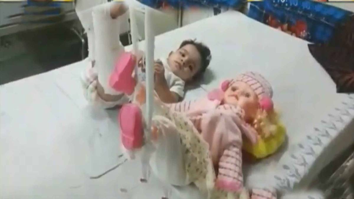 पहले गुड़िया का फिर बच्ची ने कराया अपने पैरों का प्लास्टर