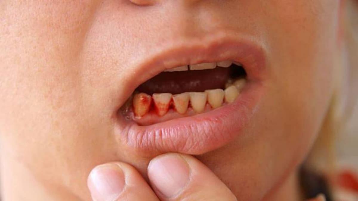 Mouth Ulcers (File Photo)