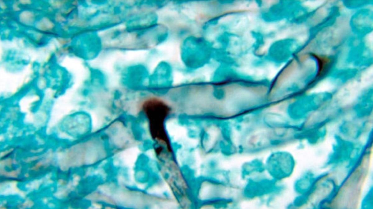 ब्लैक फंगस से भी ज्यादा खतरनाक है व्हाइट फंगस, देखें दोनो फंगस में अंतर