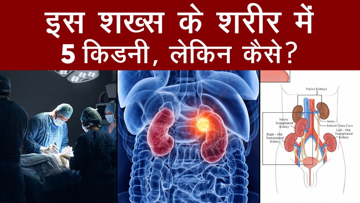 kidney transplant in madras medical mission