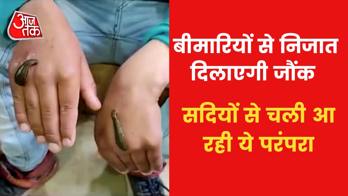 Leech therapy In srinagar
