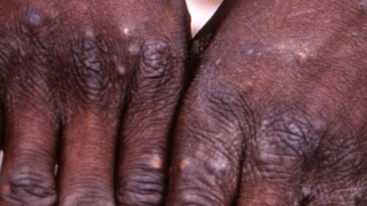 monkeypox comparison with corona