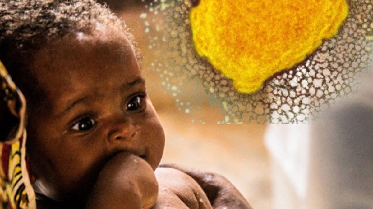 After Corona now the threat of Monkeypox virus MMT