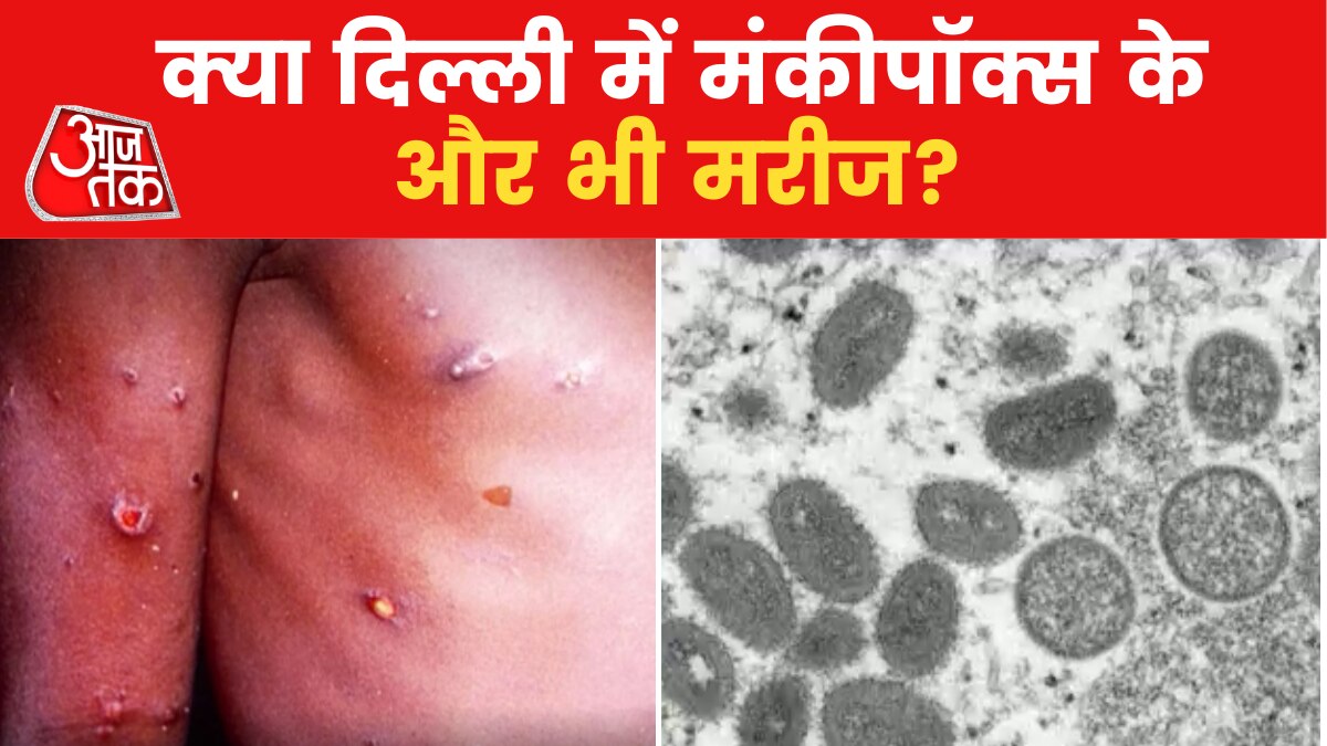 Monkeypox patients in india