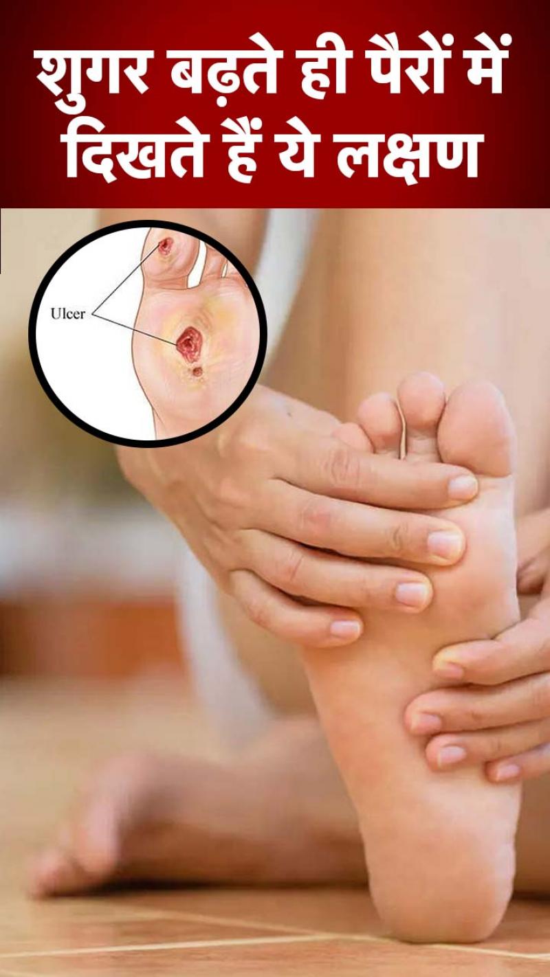 Diabetes Symptoms: खतरनाक हो सकता है बढ़ता शुगर, पैर काटने की आ सकती है नौबत
