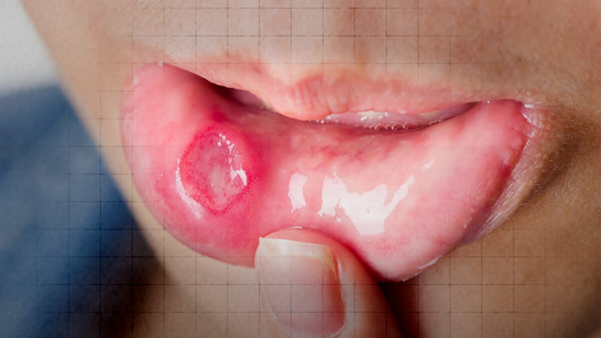 Signs of mouth cancer