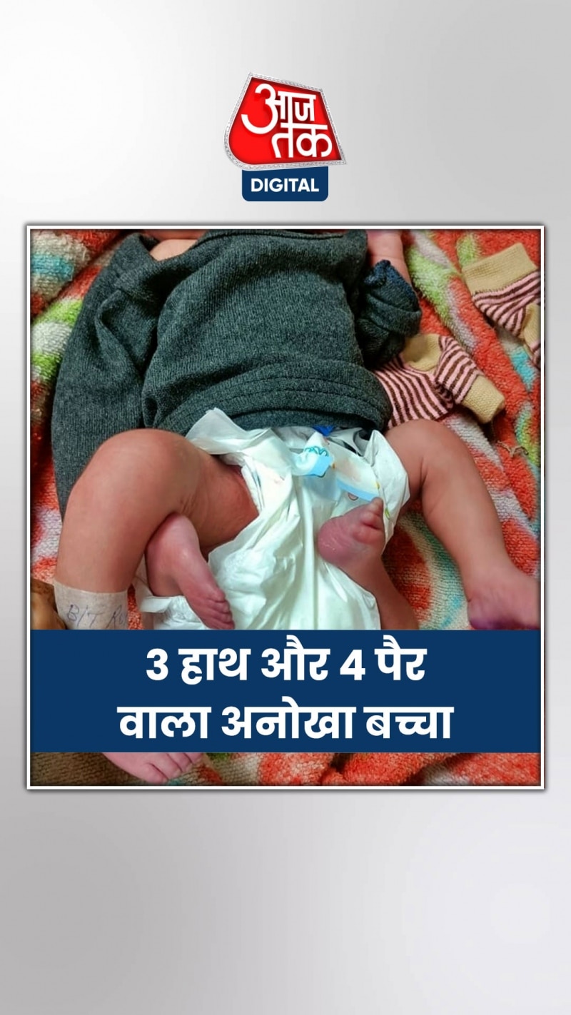 यूपी के मेरठ में पैदा हुए इस बच्चे को देखकर डॉक्टर भी हैरान 
