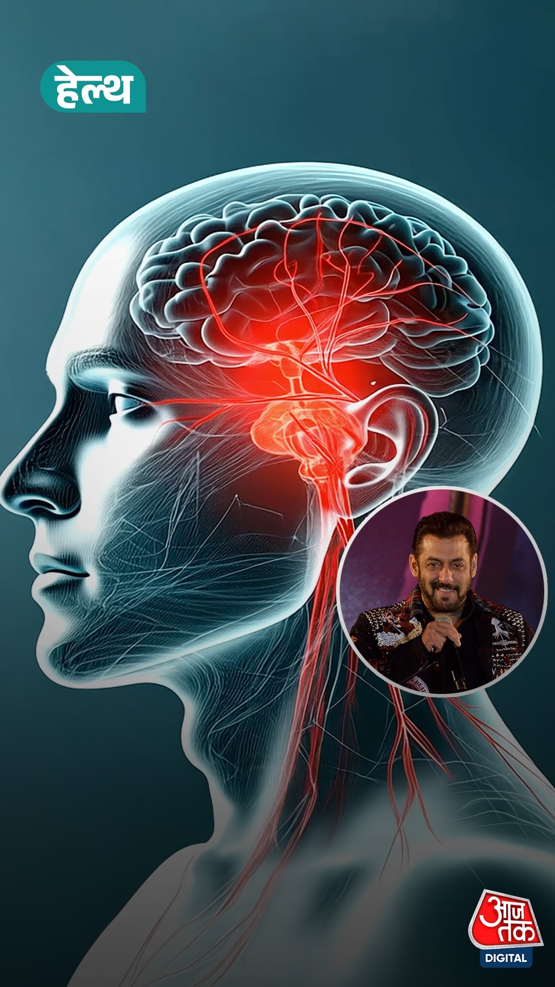 Salman की बीमारी 'Arteriovenous malformation' क्या है?