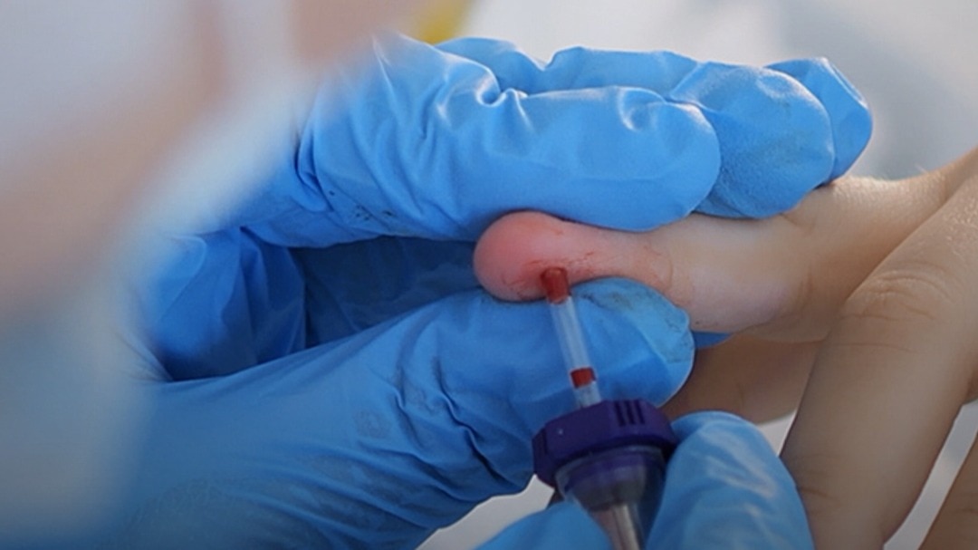 gwada-negative blood group found in france 