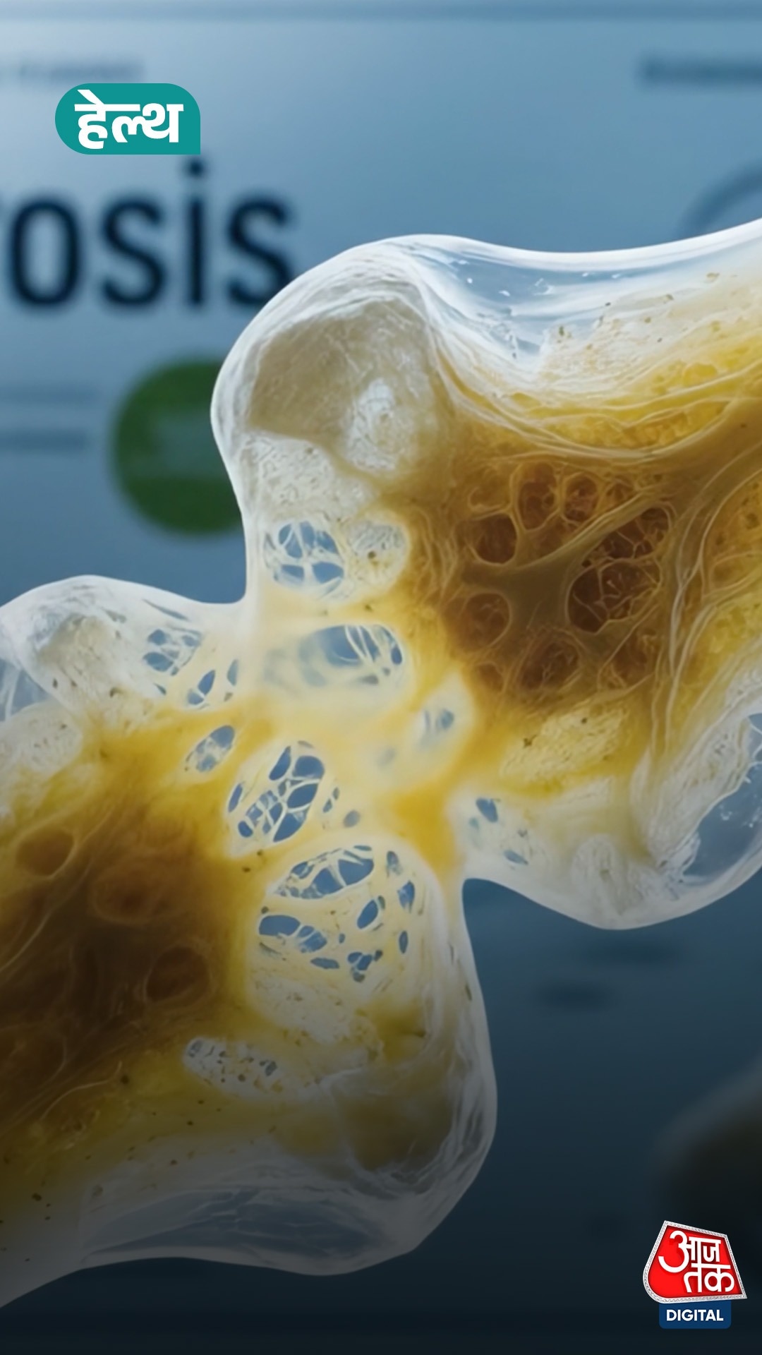 6 करोड़ भारतीयों की हड्डियां कमजोर! जानें बचाव के तरीके