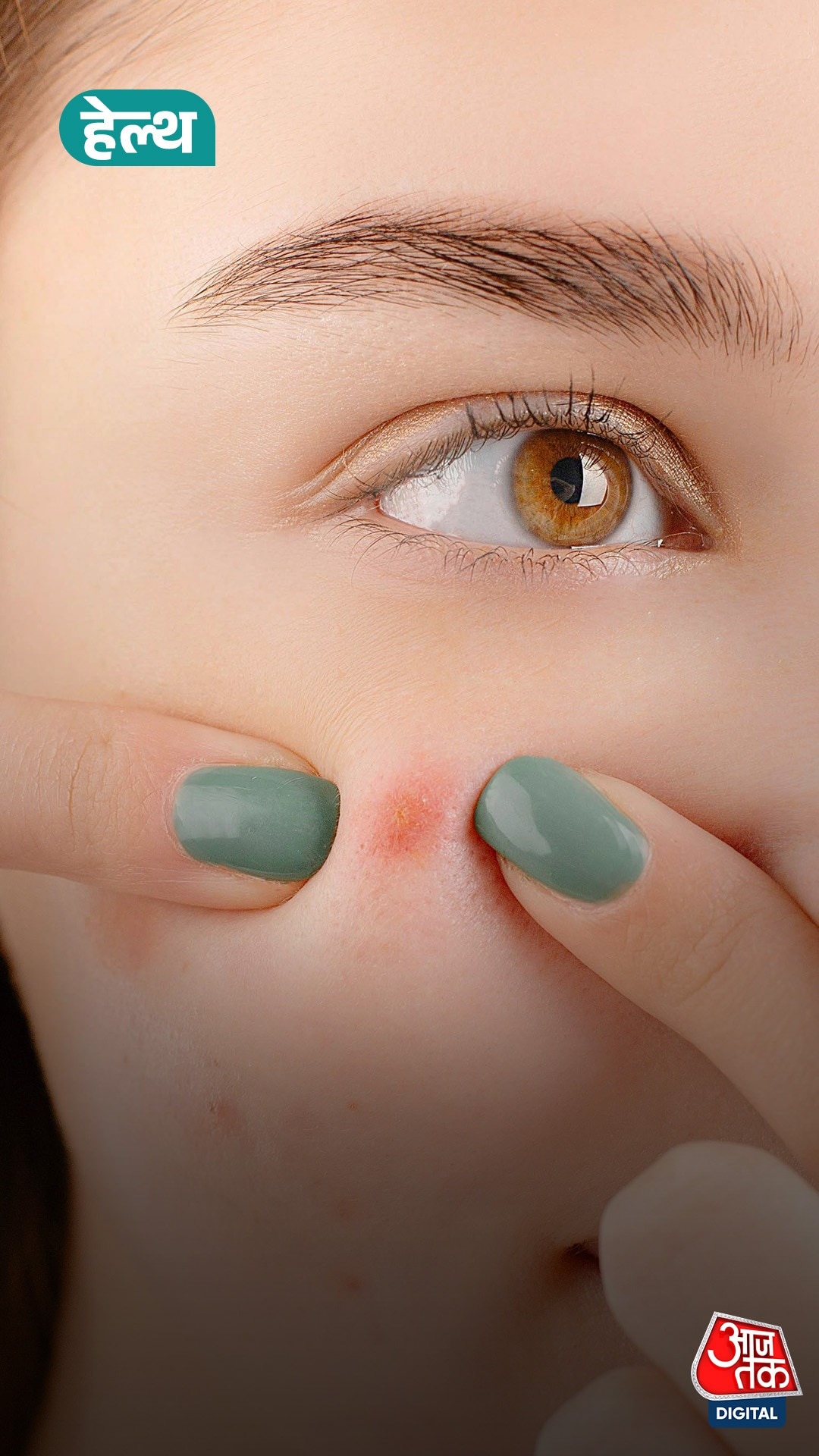 Tamannaah Bhatia के पिंपल्स हैक पर डॉक्टर की राय