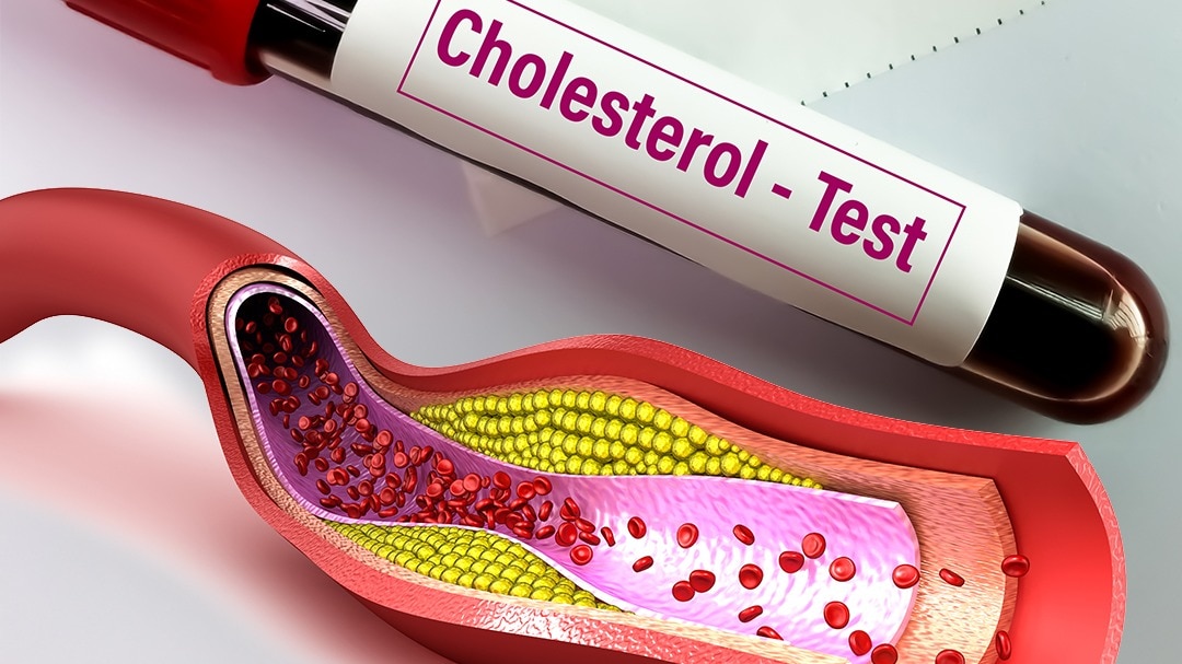 Cholesterol 