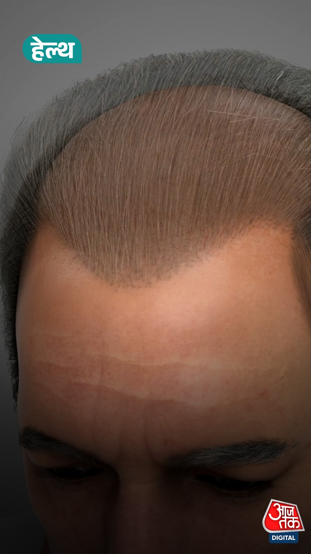 20 दिन में उगे बाल... Taiwan के वैज्ञानिकों का सीरम