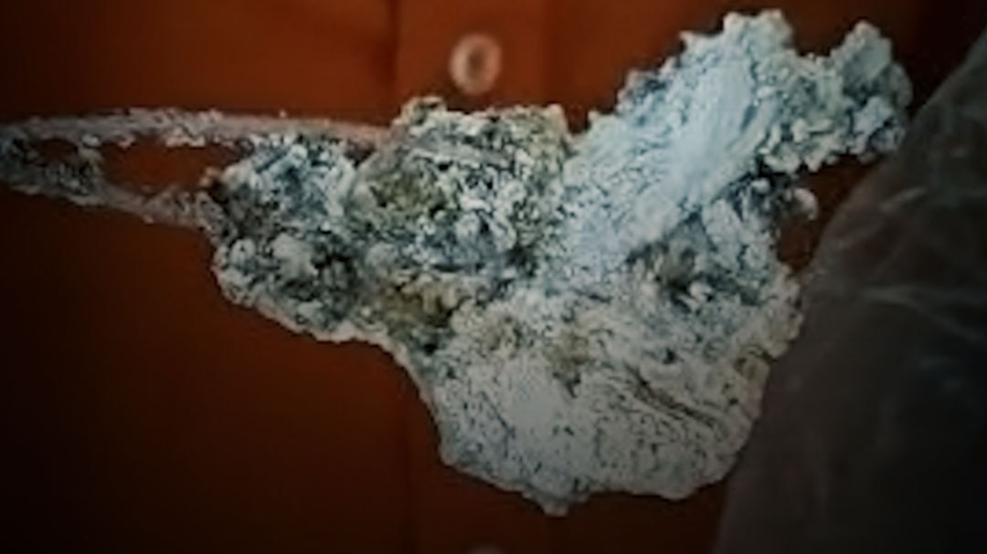 Surgical scissors found in ashes of funeral in Sehore