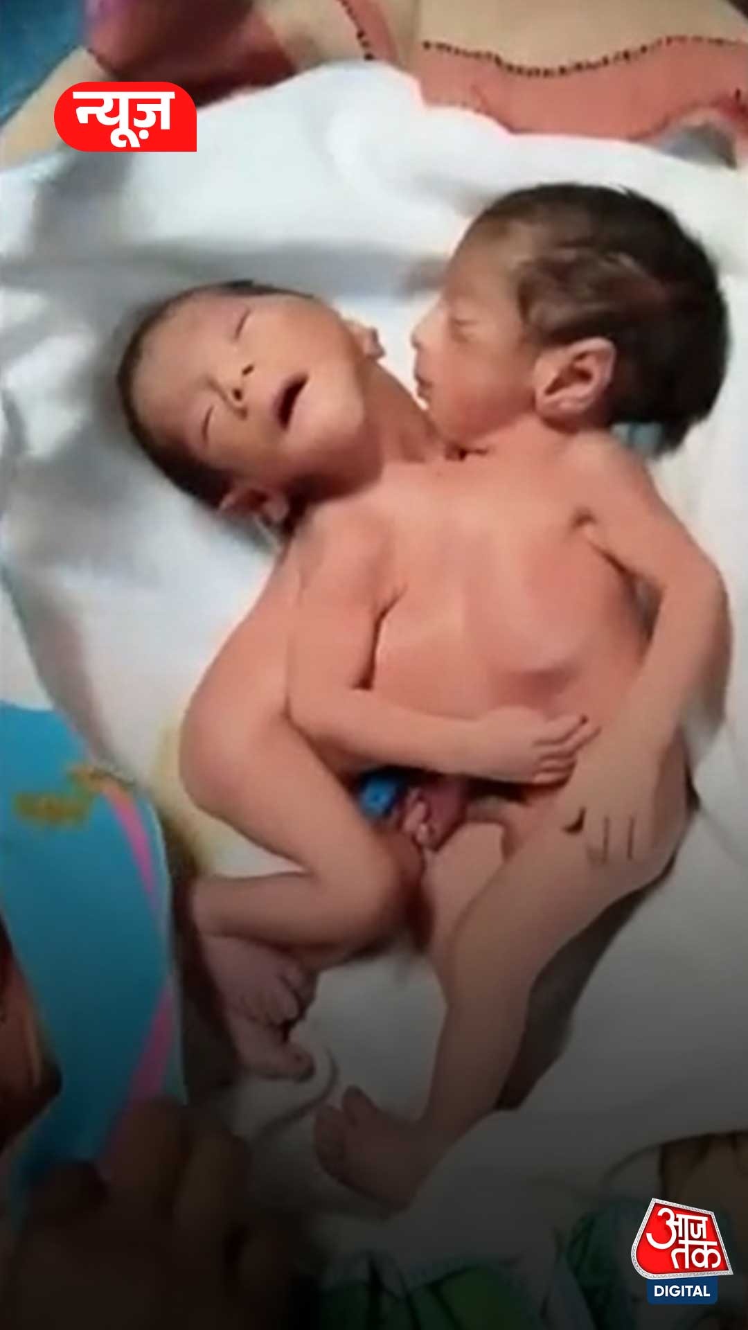 Conjoined torso babies born in Aligarh