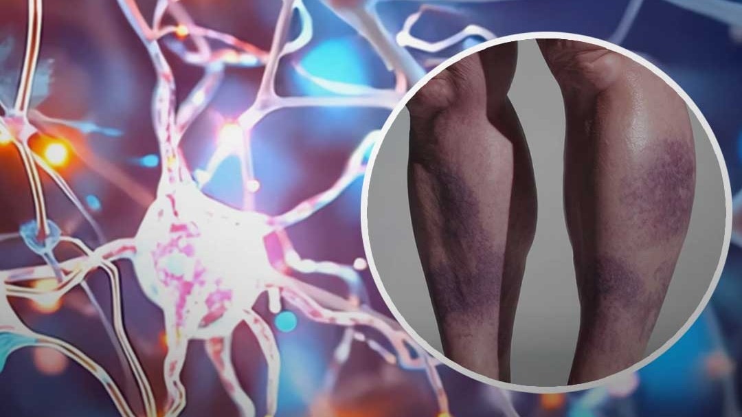 Deep vein thrombosis