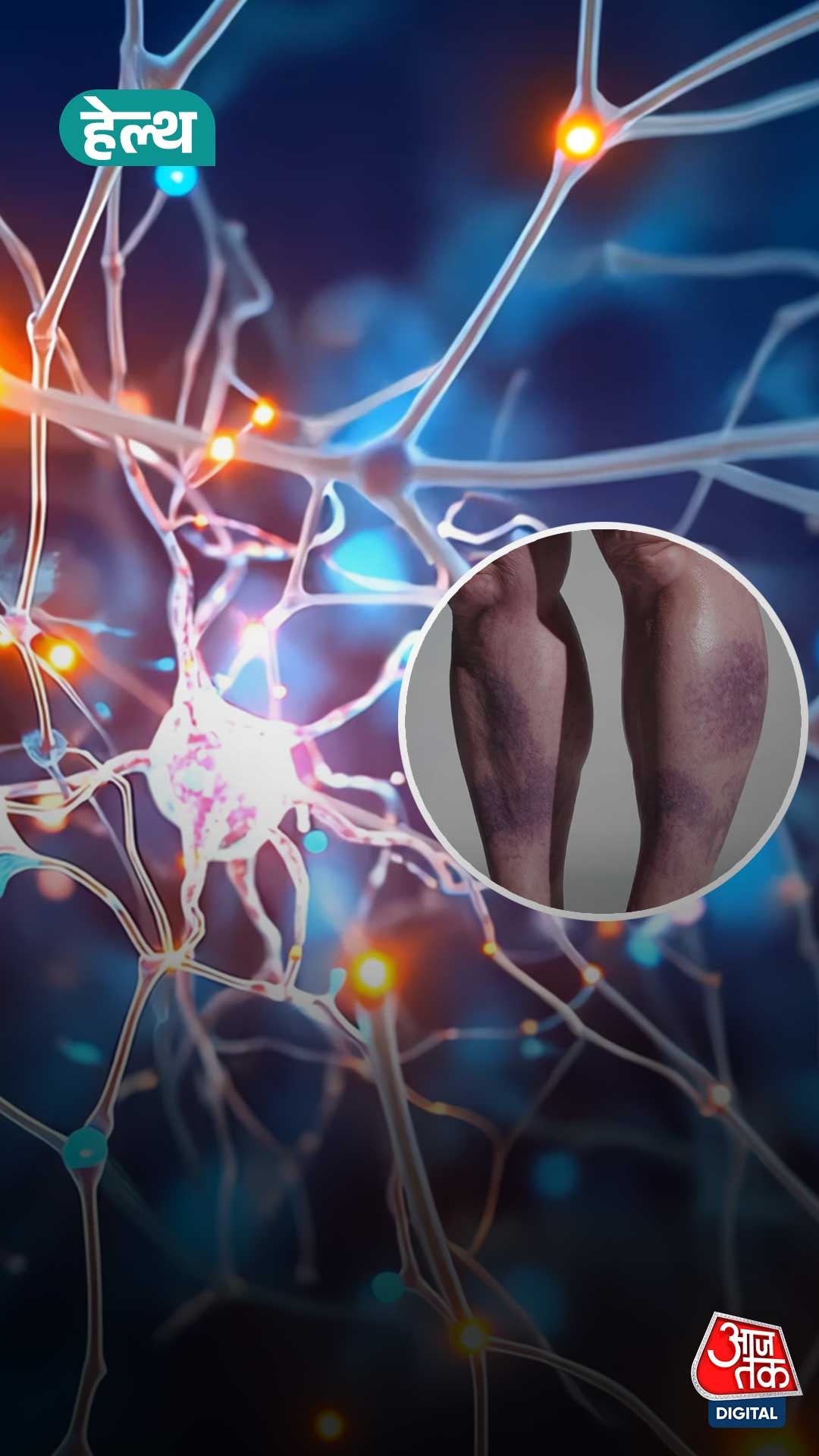 Deep vein thrombosis