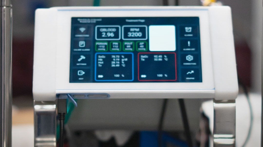 40 घंटे दिल बंद, फिर भी ज़िंदा! ECMO तकनीक से बची जान