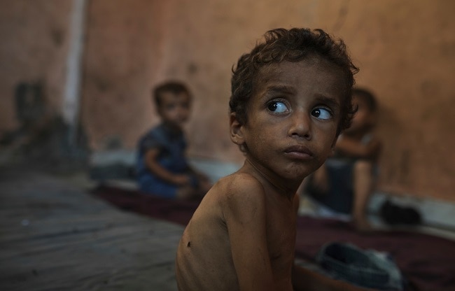 gaza malnourished child with mother (Photo- AP) gaza malnourished child with mother (Photo- AP)