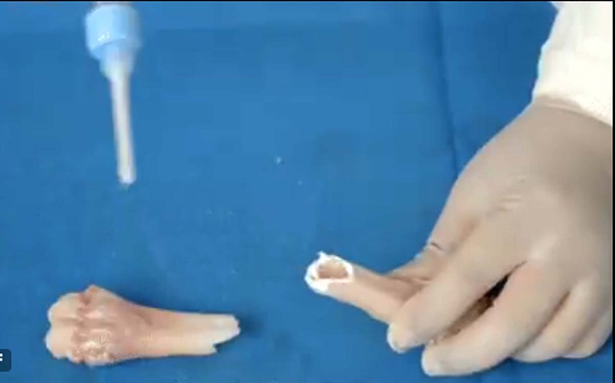 चीन का चमत्कार, टूटी हड्डी अब सिर्फ 3 मिनट में जुड़ जाएगी इस खास ग्लू से, मेडिकल साइंस भी हैरान 2 China Worlds First Bone Glue Joins Broken Bones In 2 3 Minutes